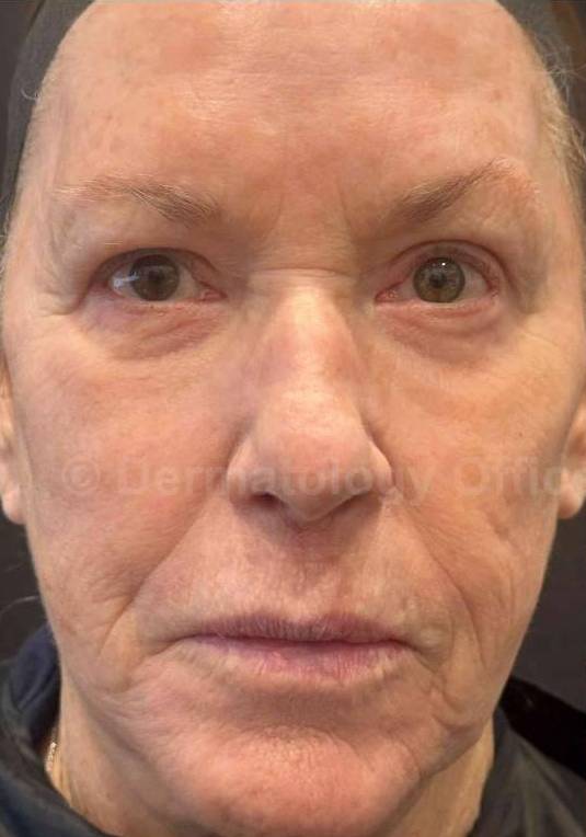 Restylane Before and After Case 17 Before