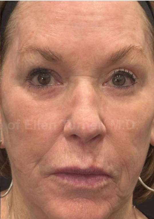 Restylane Before and After Case 17 After