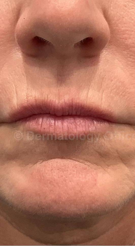 Restylane Before and After Case 16 Before