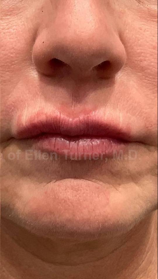 Restylane Before and After Case 16 After