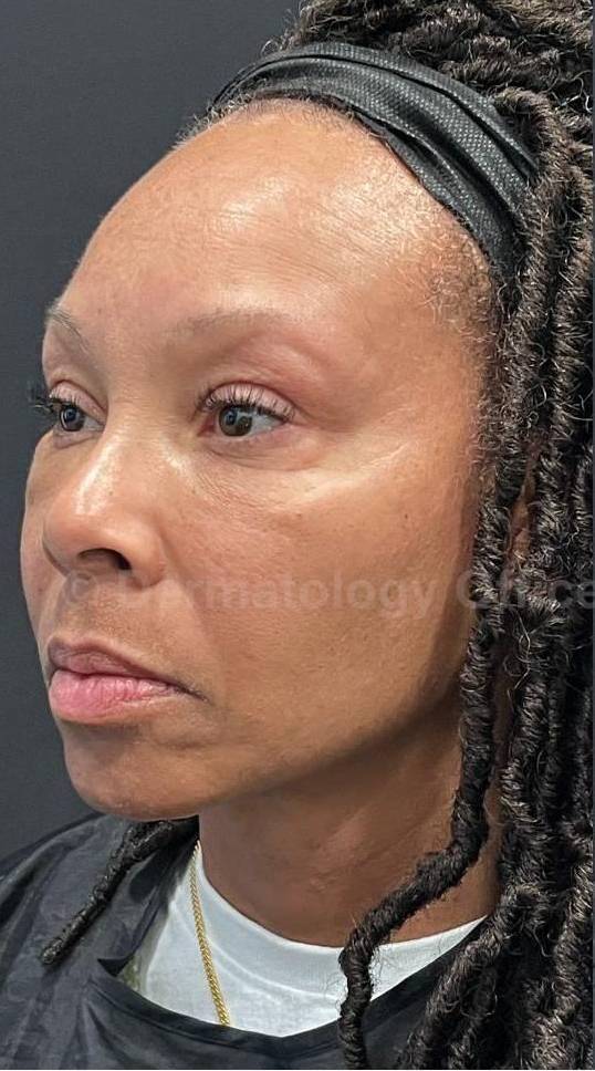 Restylane Before and After Case 15 Before