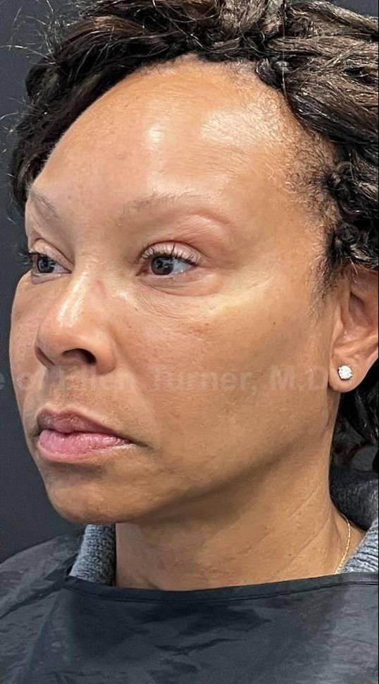 Restylane Before and After Case 15 After