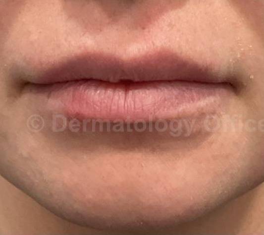Restylane Before and After Case 14 Before