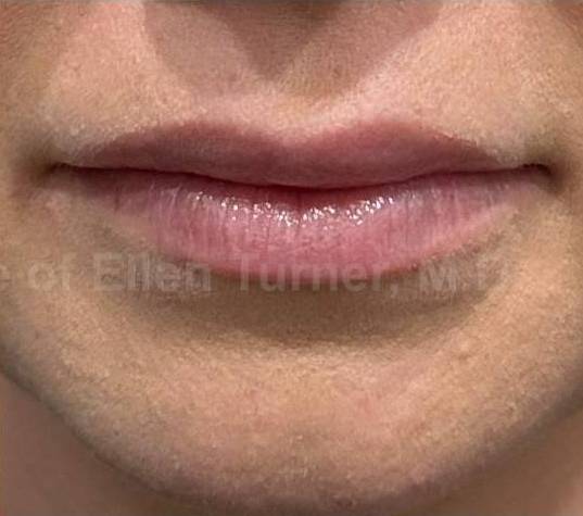 Restylane Before and After Case 14 After