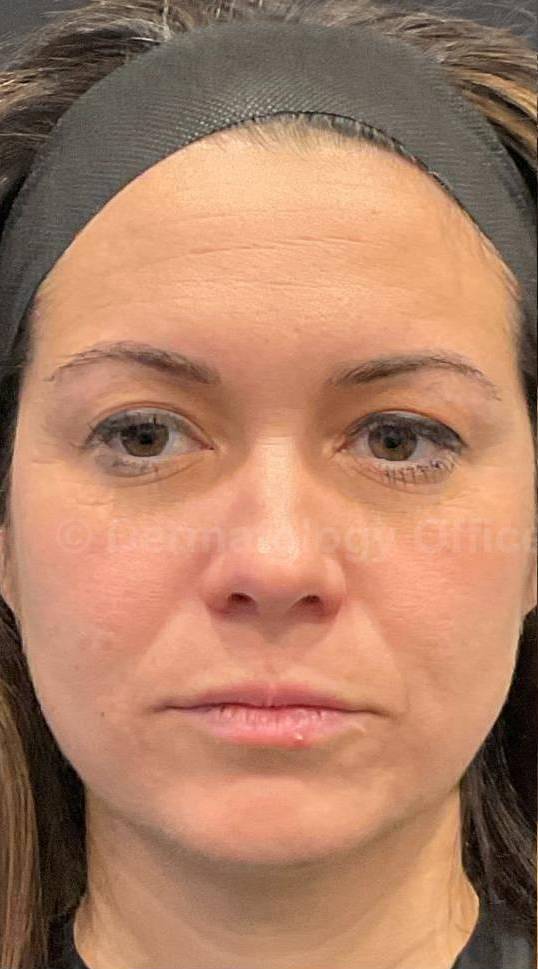 Restylane Before and After Case 13 Before