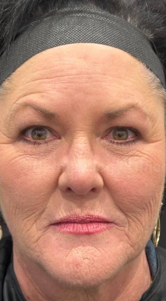 Restylane Before and After Case 12 Before