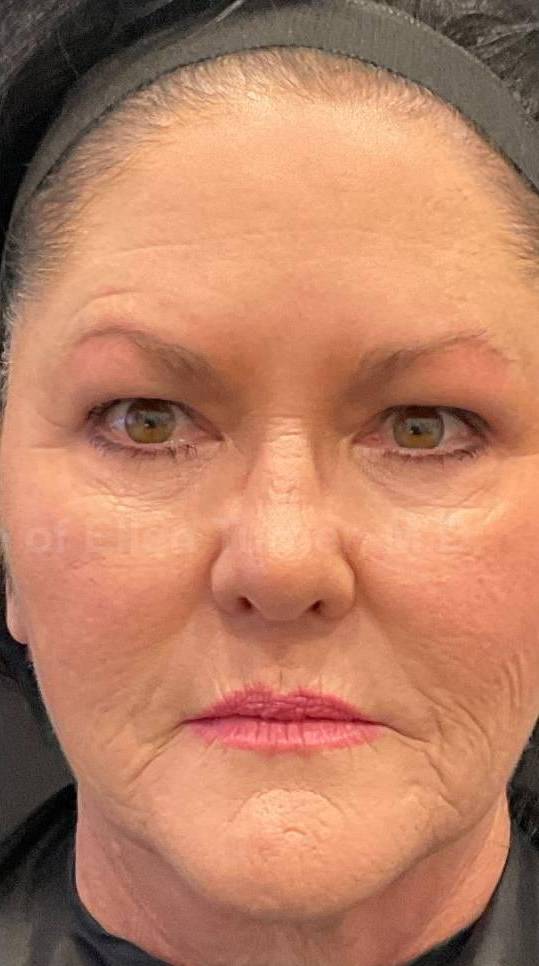 Restylane Before and After Case 12 After