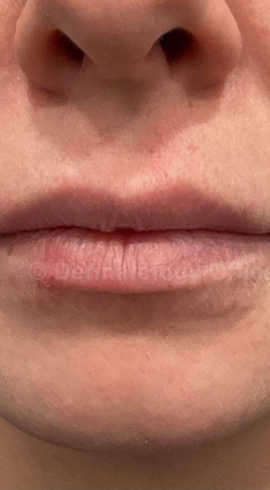 Restylane Before and After Case 11 Before