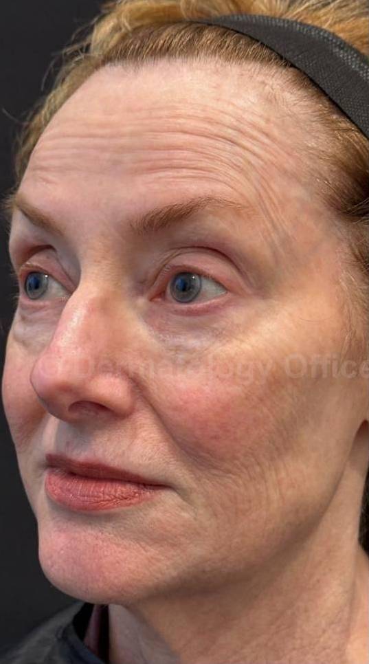 Restylane Before and After Case 10 Before