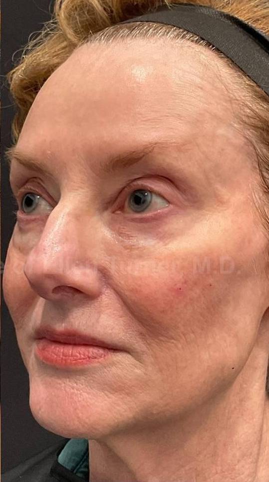 Restylane Before and After Case 10 After