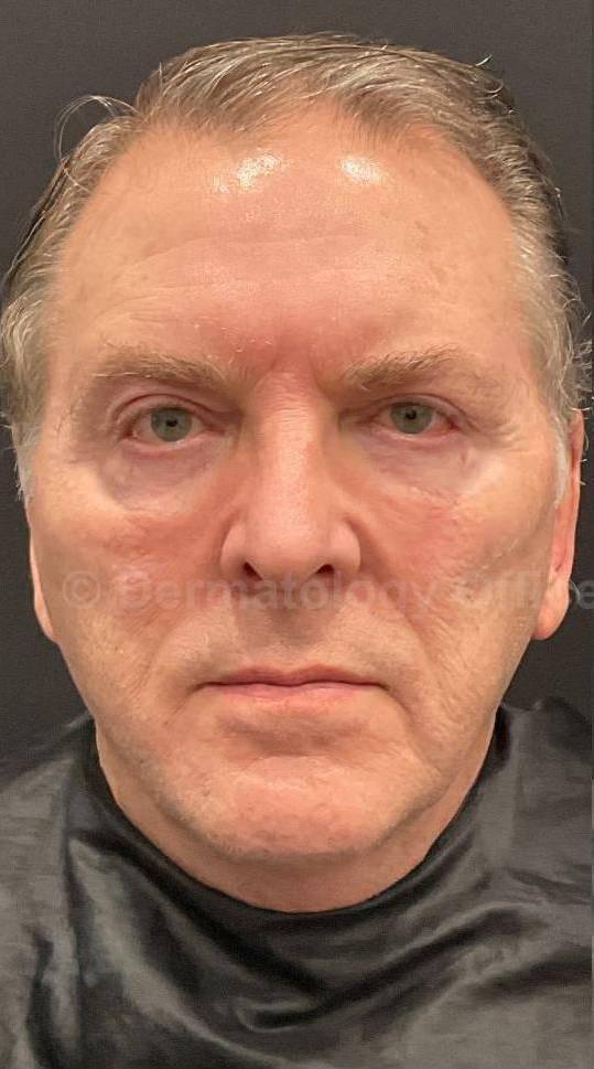 Restylane Before and After Case 9 Before