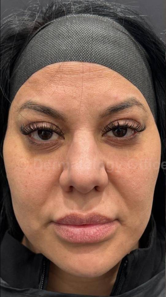 Restylane Before and After Case 8 Before