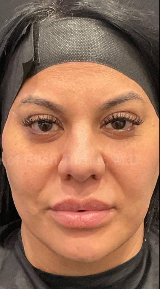 Restylane Before and After Case 8 After