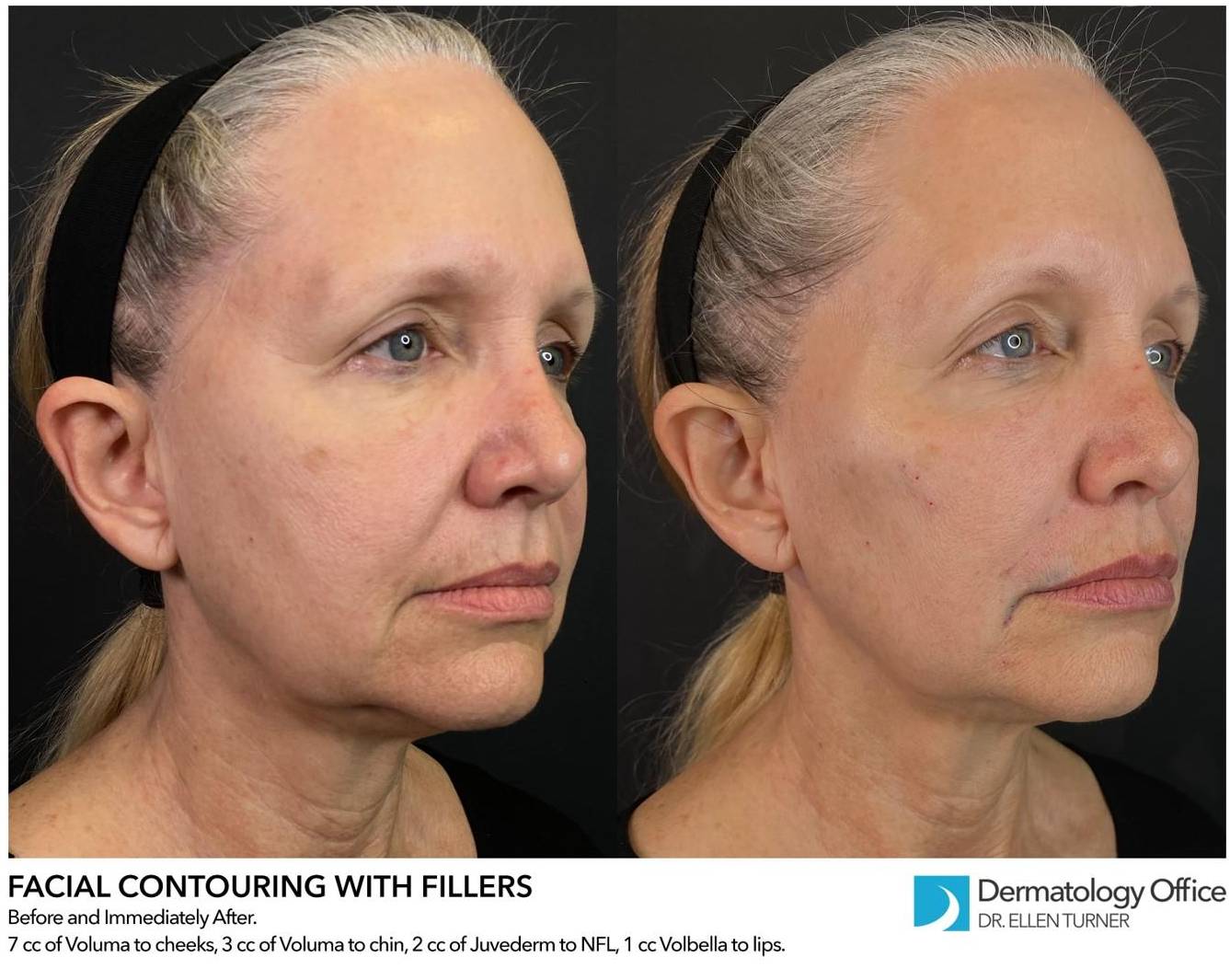 Juvederm (2 Syringes) Case-7 