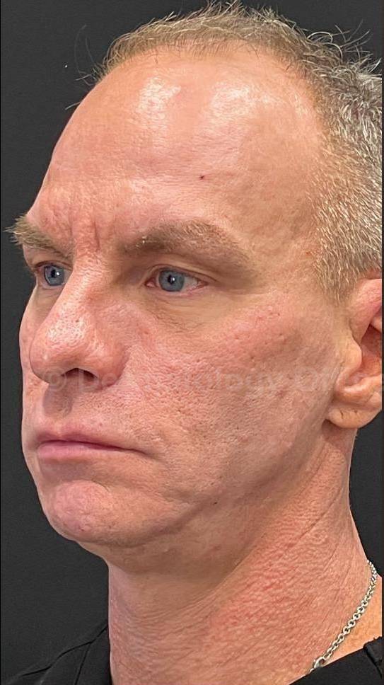 Restylane Before and After Case 7 Before