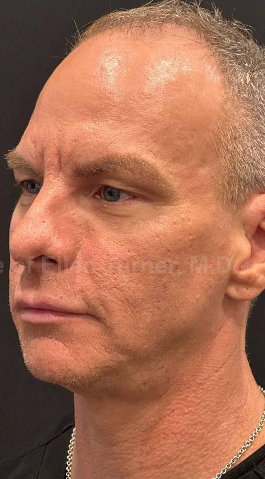 Restylane Before and After Case 7 After