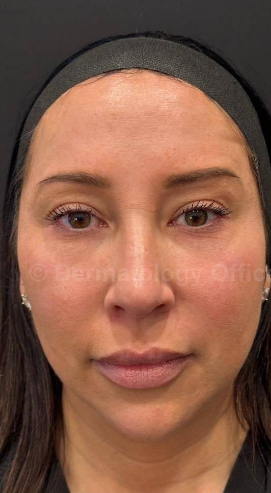 Restylane Before and After Case 6 Before