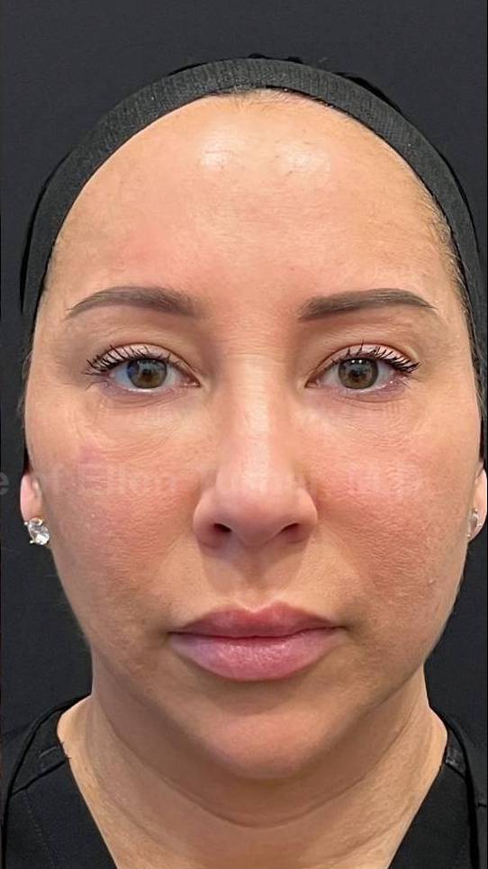 Restylane Before and After Case 6 After