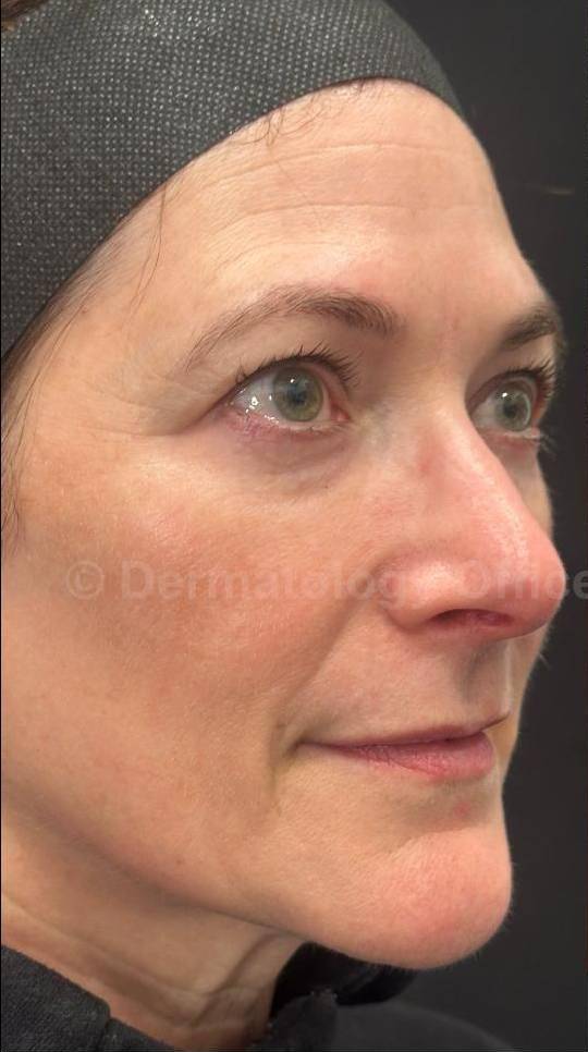 Restylane Before and After Case 5 Before