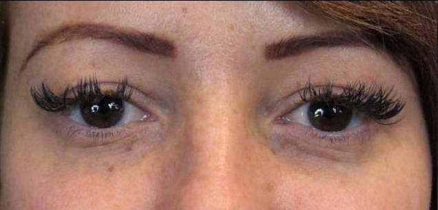 Restylane Before and After Case 4 Before