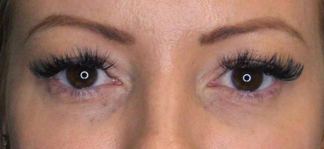 Restylane Before and After Case 4 After