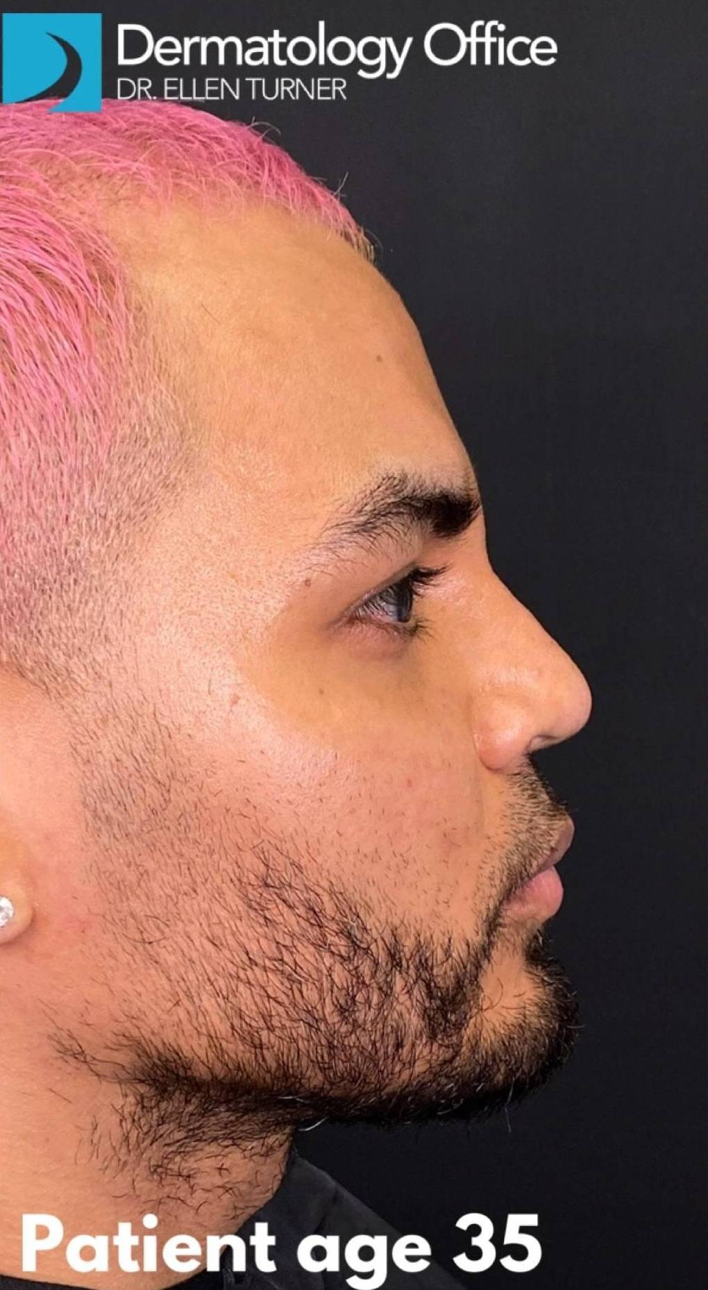 Teoxane RHA Filler (3 Syringes RHA4) Case 3 Before