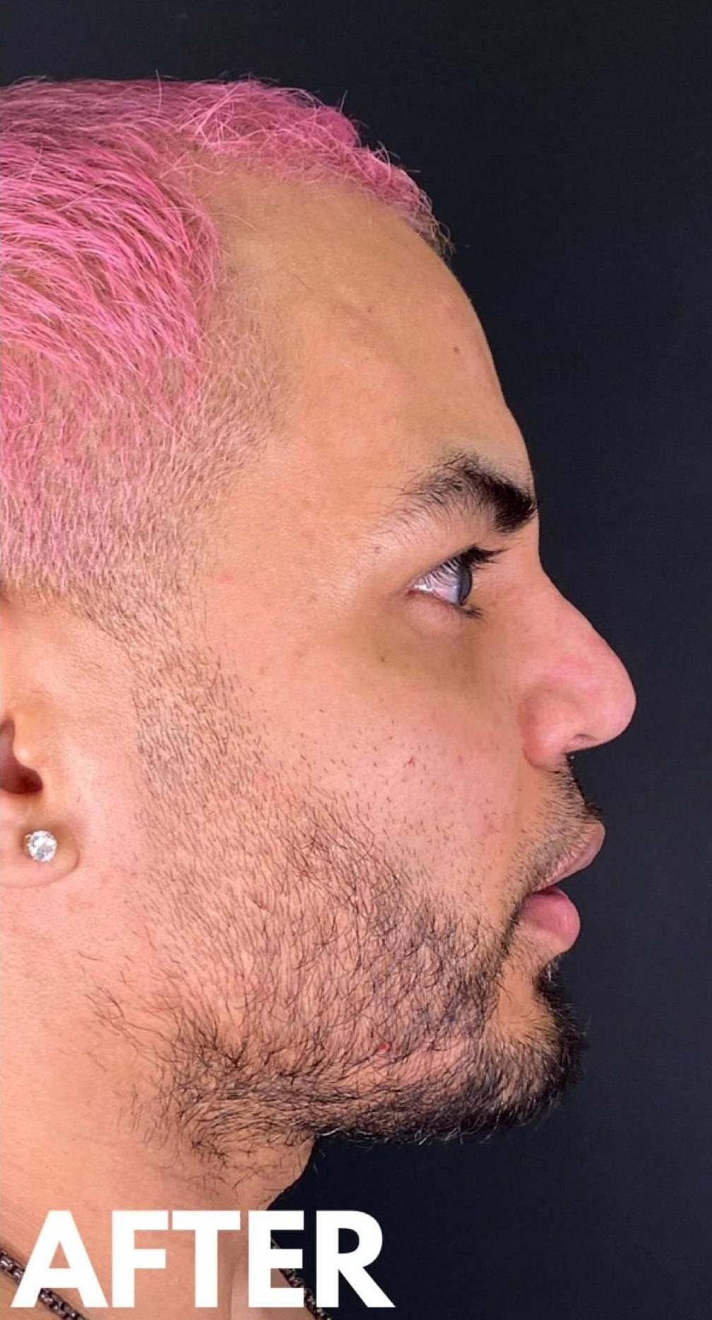 Teoxane RHA Filler (3 Syringes RHA4) Case 3 After