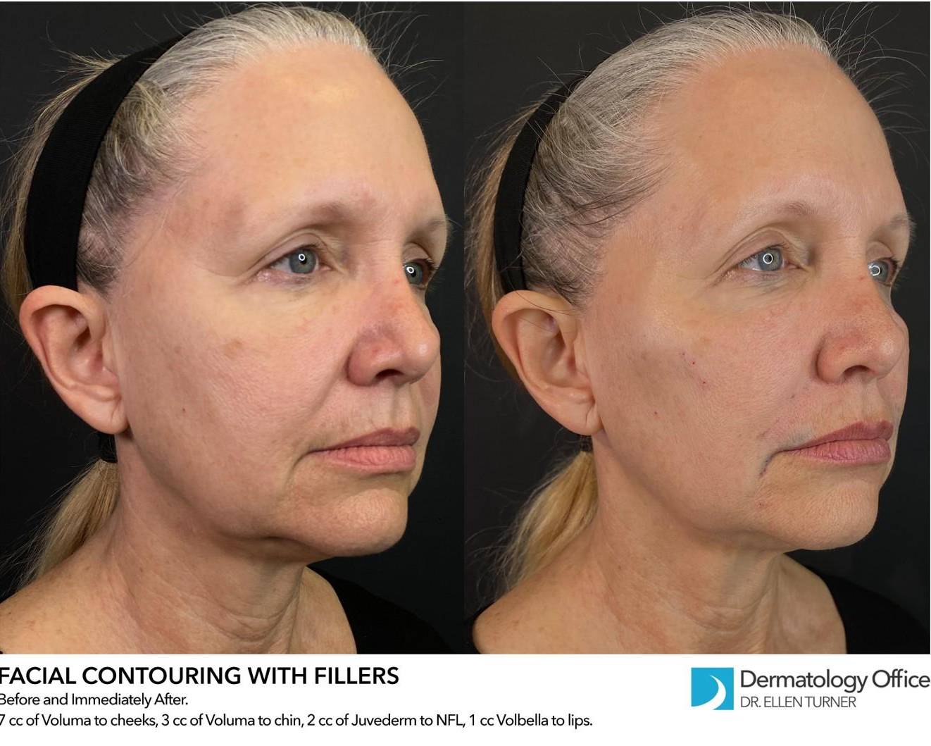 Volbella (1 syringe) Before and After Case 3 
