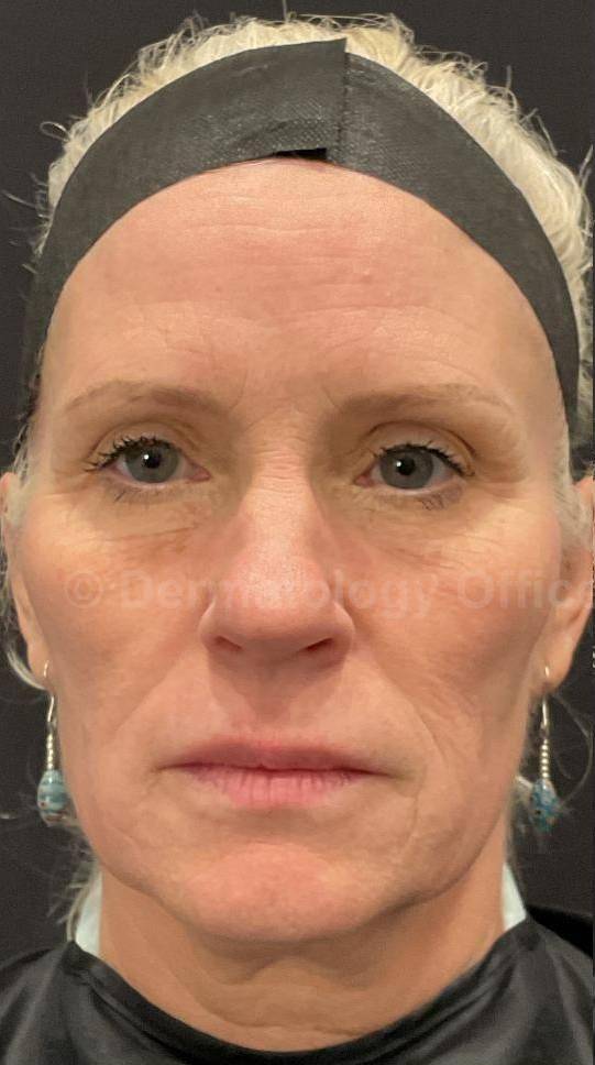 Teoxane Revance Filler Case 6 Before