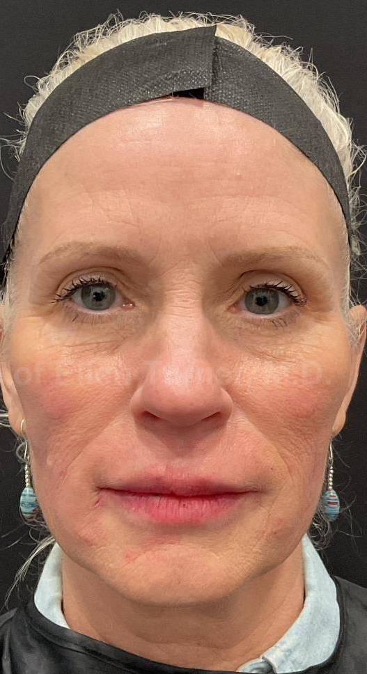 Teoxane Revance Filler Case 6 After