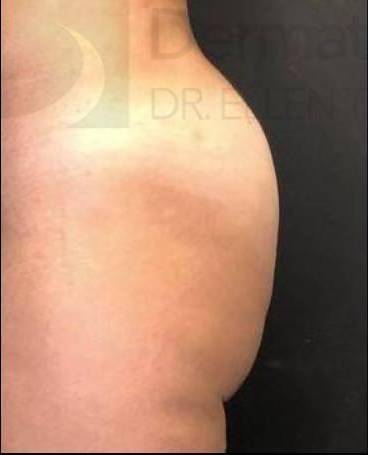 Sculptra (15 Vials) Case 1 Before