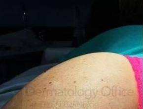 Sculptra (1 vials) Case 4 Before