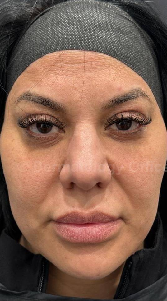 Sculptra Before and After Case- 7 Before