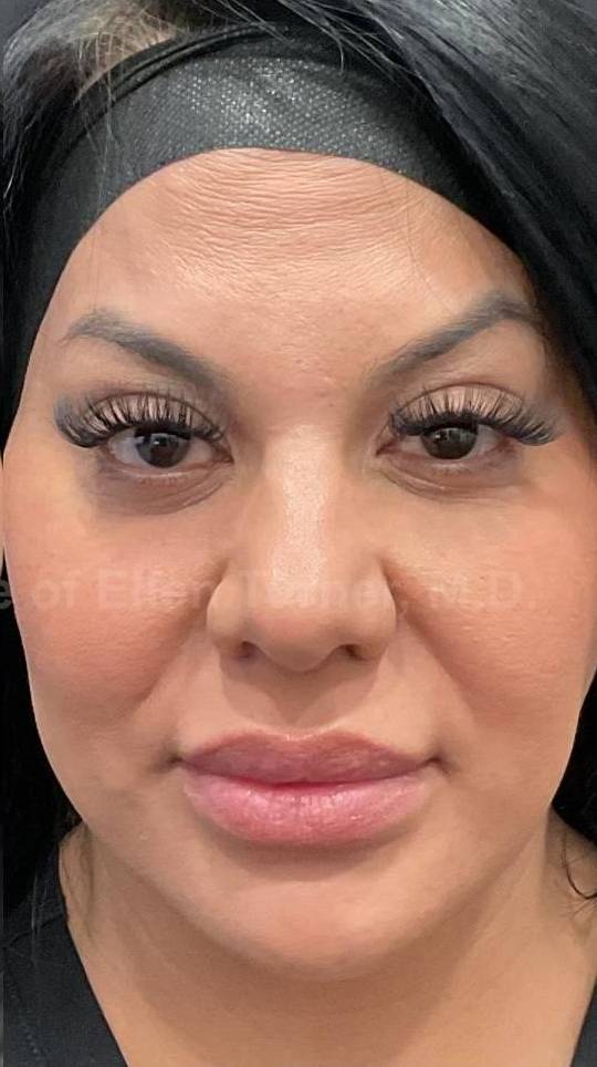 Sculptra Before and After Case- 7 After