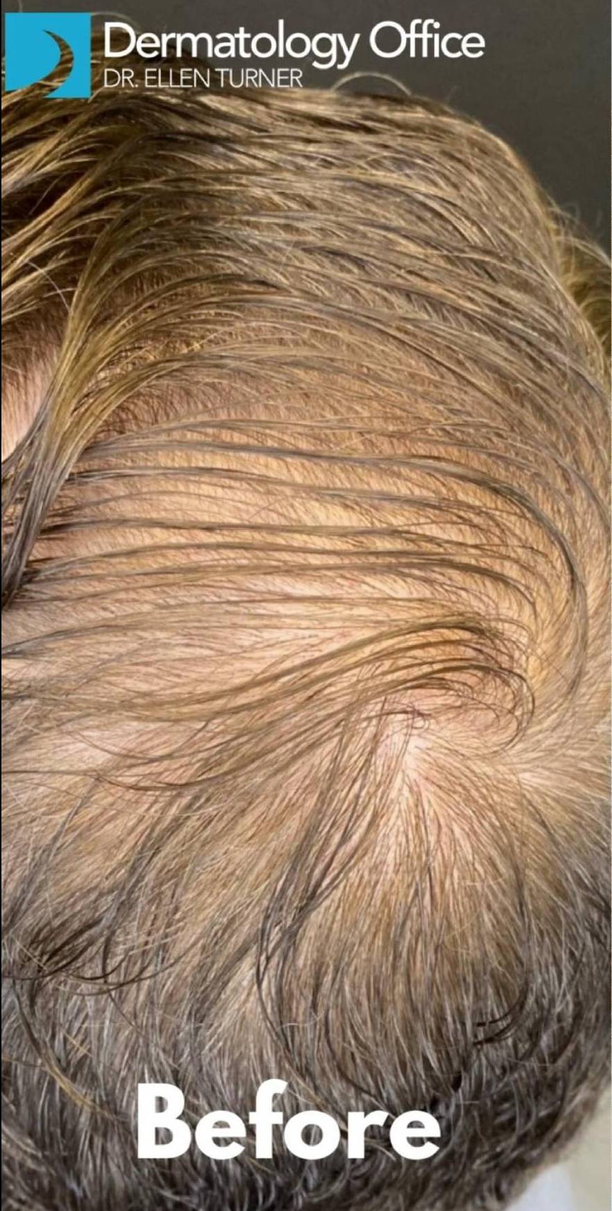 Exoflo-Hair Restoration Before and After Case 2 Before