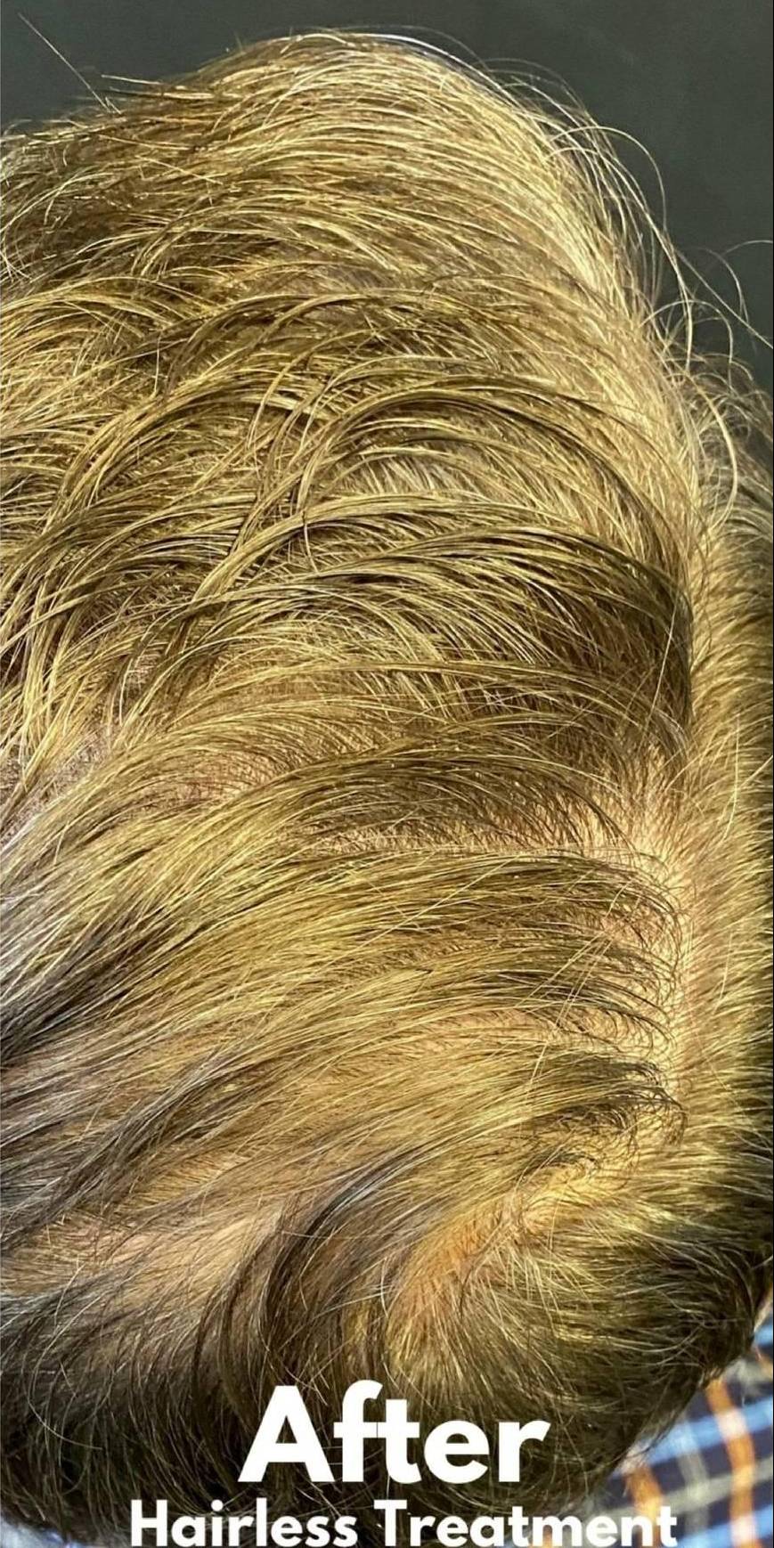 Exoflo-Hair Restoration Before and After Case 2 After