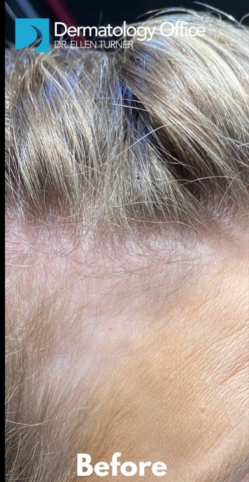 Exoflo-Hair Restoration Before and After Case 1 Before