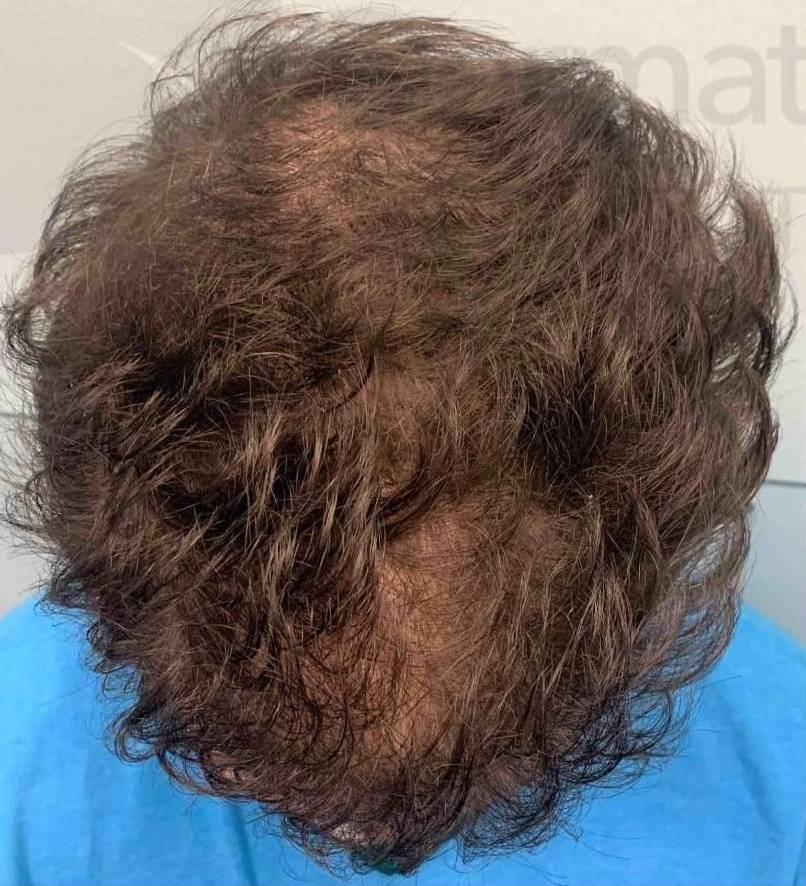 Exoflo Hair Restoration (2 Syringes) Case 8 Before