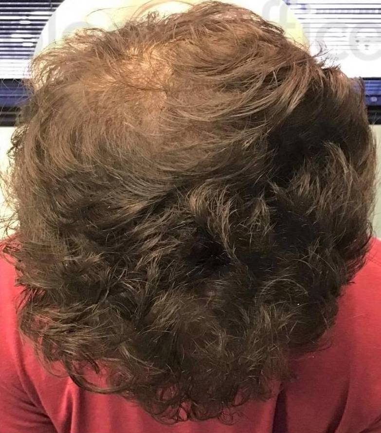 Exoflo Hair Restoration (2 Syringes) Case 8 After