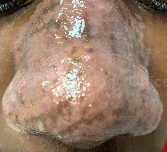 Laser Resurfacing Case-2 Before