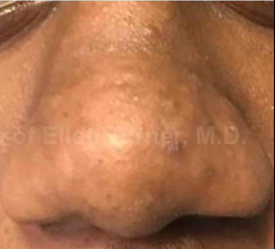 Laser Resurfacing Case-2 After
