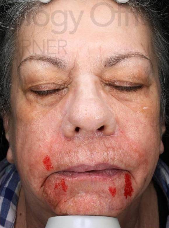 Laser Resurfacing (1 Treatment) Case-1 After