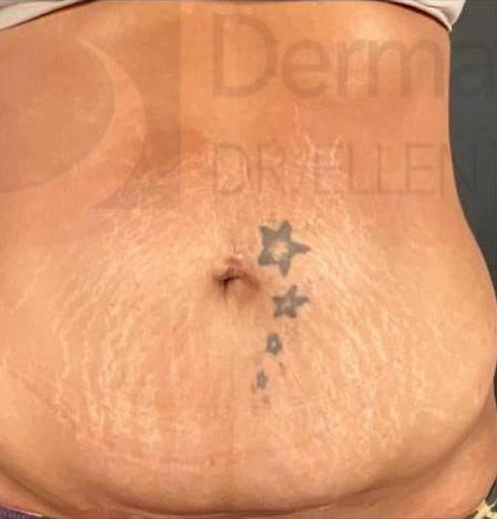 Cutera Secret RF Microneedling (1st Treatment) Case-1 Before