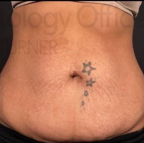 Cutera Secret RF Microneedling (1st Treatment) Case-1 After