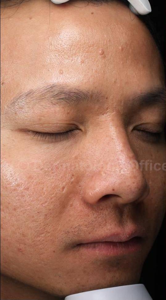 HALO™ Before and After Case 10 Before