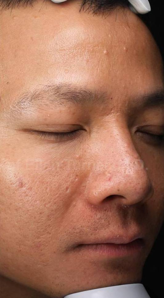 HALO™ Before and After Case 10 After