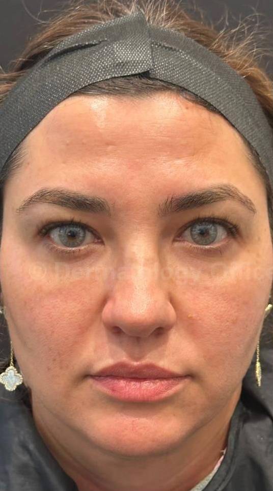 HALO™ Before and After Case 9 Before