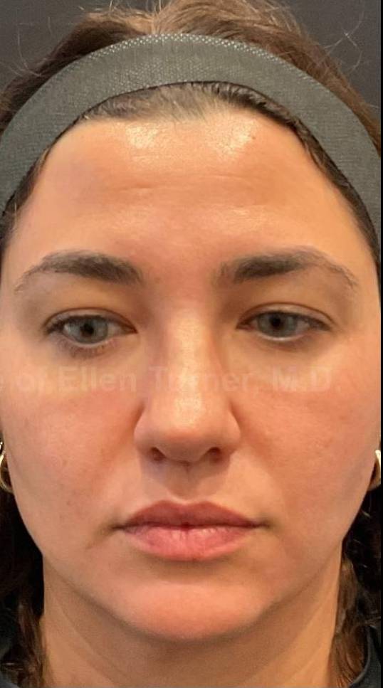 HALO™ Before and After Case 9 After