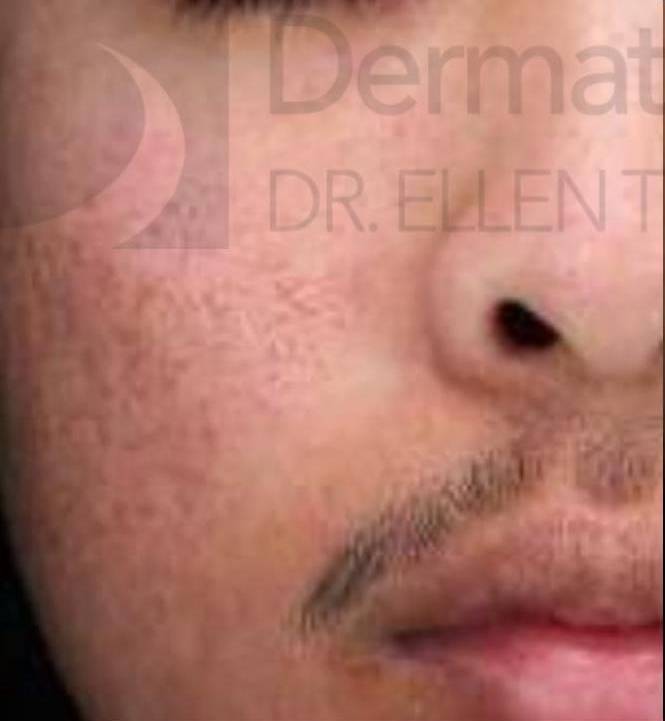 HALO™ (2 Treatment) Case 1 Before