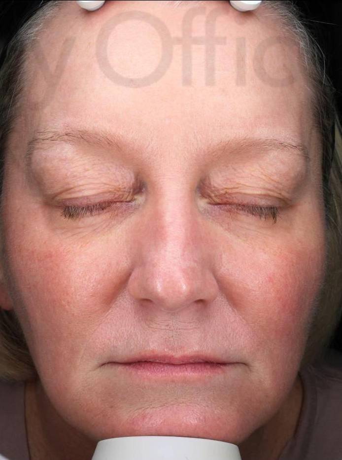 IPL-Photofacial/BBL BroadBand Laser Case-11 After